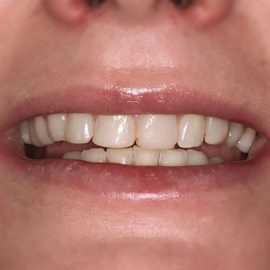 edge bonding - before - teeth sensitivity - 3Dental